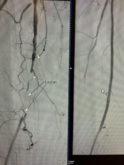 Pre-and-Post-Angiogram_3.PNG
