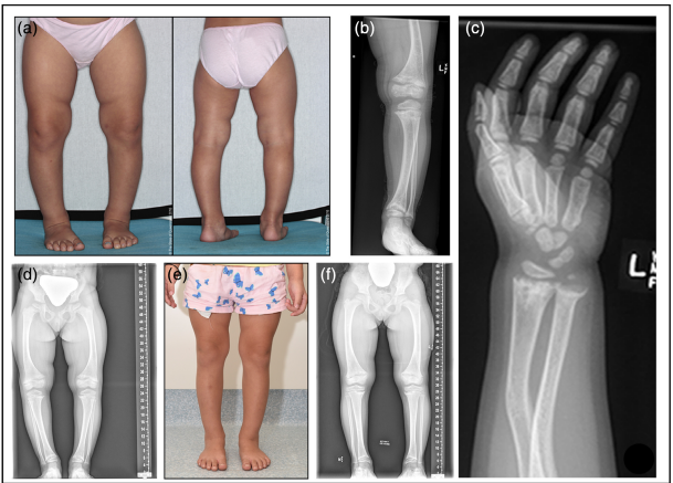 Figure 1. (a) Lower limb images at diagnosis showing genus varus, widened metaphyses and torsion at the tibia bilaterally with an intercondylar femur distance of 5 cm. (b) Left leg and (c) arm X-ray showing extensive metaphyseal fraying, widening and cupping of the physis and bowing deformity of all long bones prior to treatment for X-linked Hypophosphataemic rickets. An improvement in bone pain, leg deformity and mobility matched the resolution of metaphyseal irregularities following phosphorus and calcitriol treatment for (d) 6 months (e) 12 months and (f) 24 months.